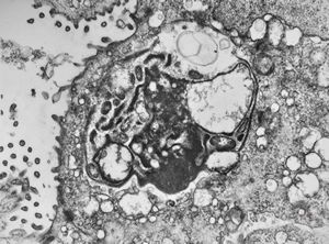 M,33y. | cryptosporidiosis - duodenum, im | munodeficient pacient M,33y. | cryptosporidiosis - duodenum, im | munodeficient pacient
